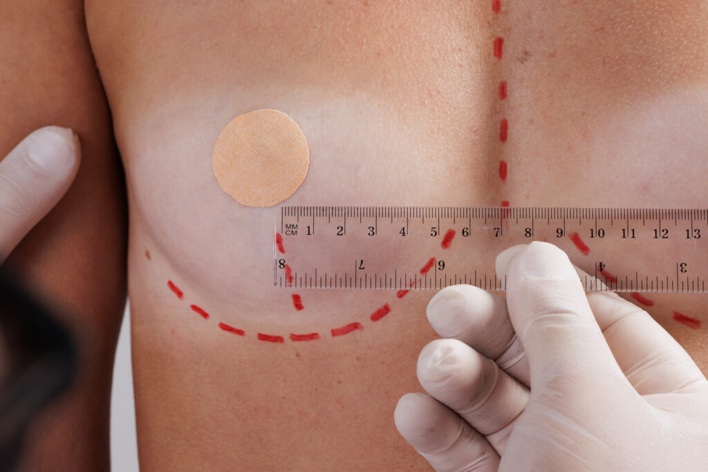 Surgeon preparing patient for breast reconstruction in NYC