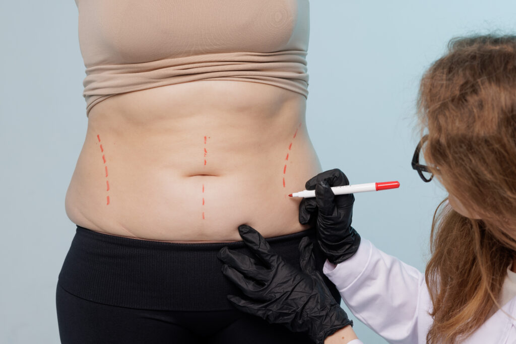 Surgeon preparing patient for tummy tuck in NYC