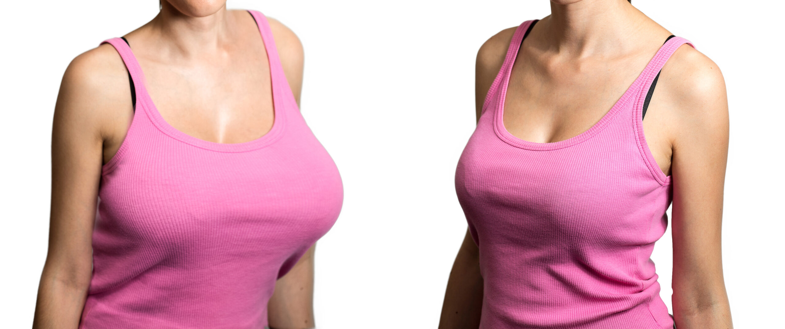Posture before and after breast reduction