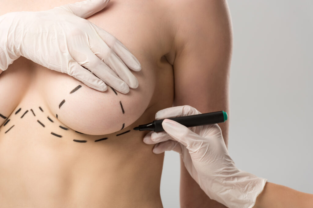 Breast reduction surgeon on Long Island preparing patient