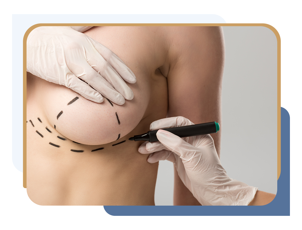 Surgeon preparing patient for breast reduction surgery