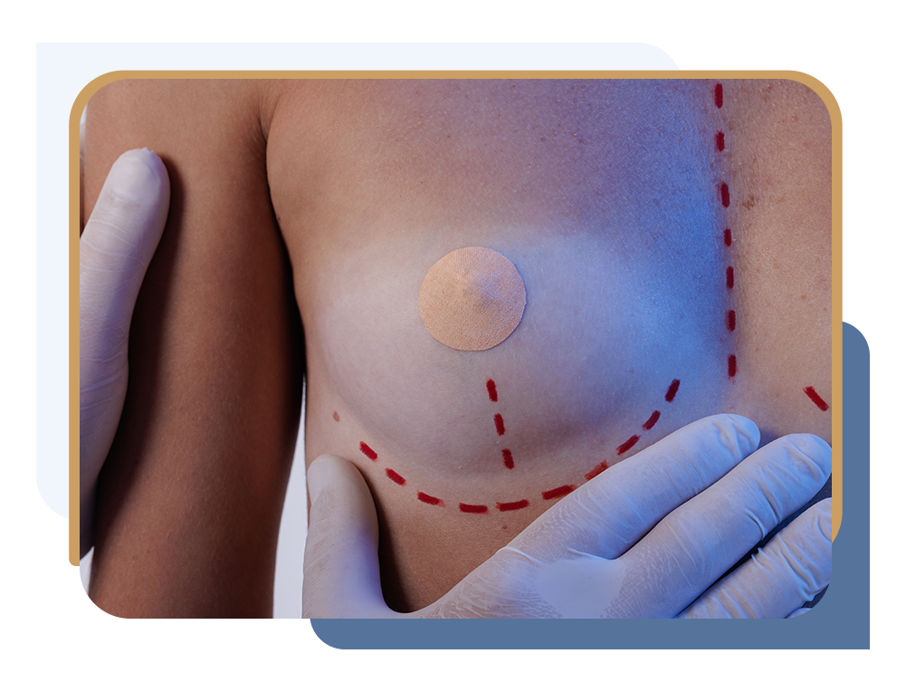 Patient with marks showing scar pattern following breast reduction