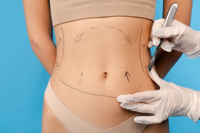 Patient before abdominoplasty surgery Long Island NYC