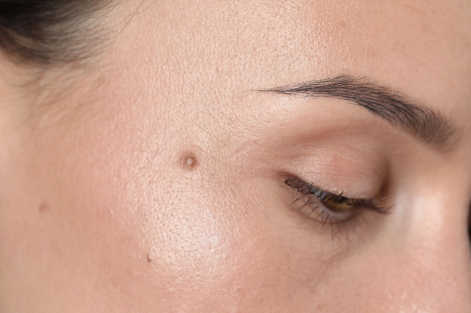 Patient before Mohs reconstruction Long Island NYC