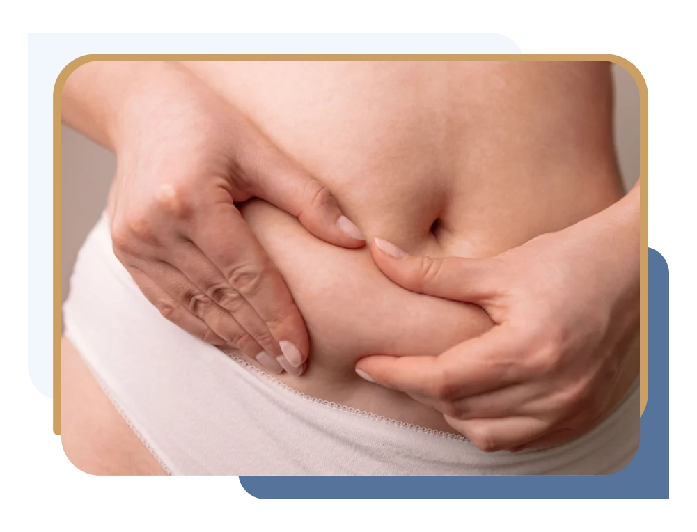 Patient holding abdominal skin, considering NYSHIP Empire Plan panniculectomy