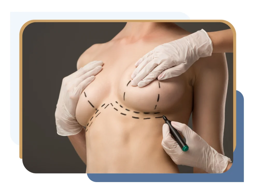 Surgeon draws lines on patient in preparation for breast reduction surgery